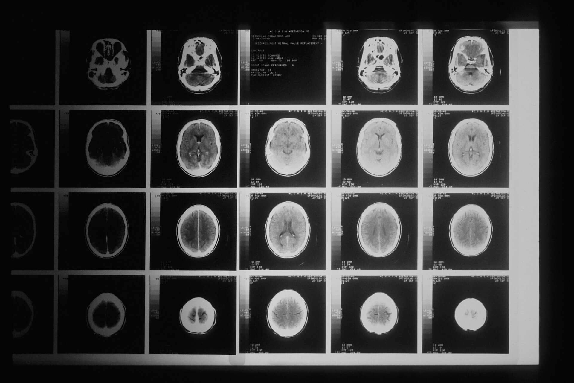 Cómo la oxigenoterapia hiperbárica puede mejorar las funciones cognitivas de los pacientes post-ictus image