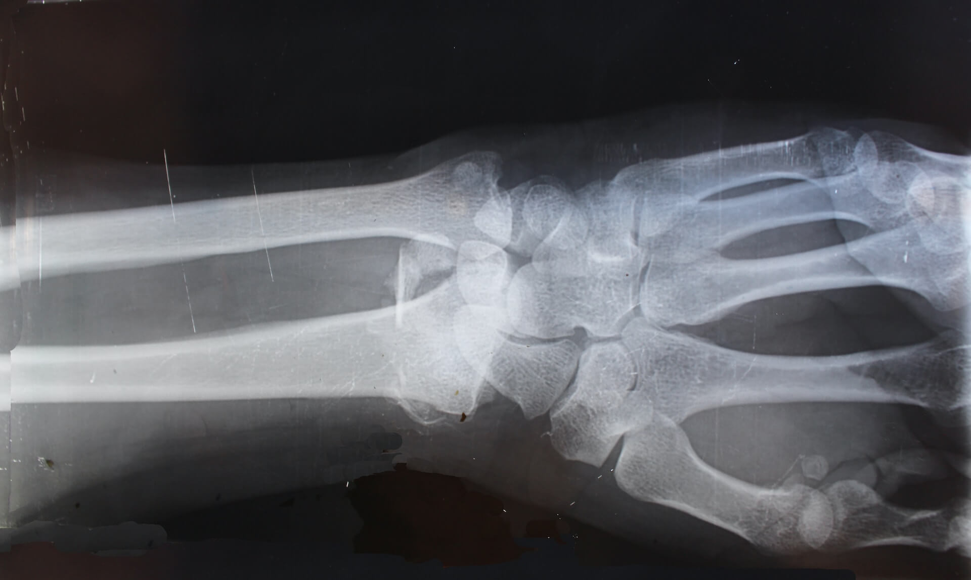 Cómo el oxígeno hiperbárico puede ayudar a tratar la osteomielitis image